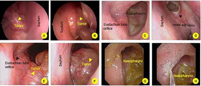Case report: Successful management of primary hyalinizing clear cell carcinoma in nasopharynx: a report of 2 cases and system analysis